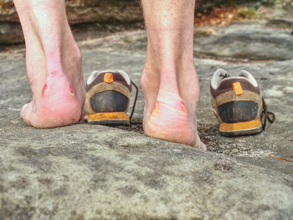 Treking a pľuzgiere. Ako zabrániť tvorbe otlakov počas túry. Ako riešiť túry a pľuzgiere.